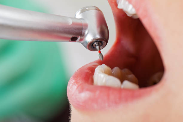 Best Emergency Root Canal Treatment in Canton, GA